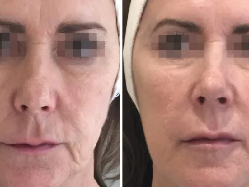 Voor en na een Profhilo behandeling? Bij De Botoxbar Voor en na een Profhilo behandeling? Bij De Botoxbar