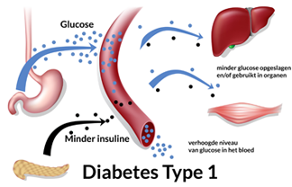 Wat is het verschil tussen diabetes type 1 en 2