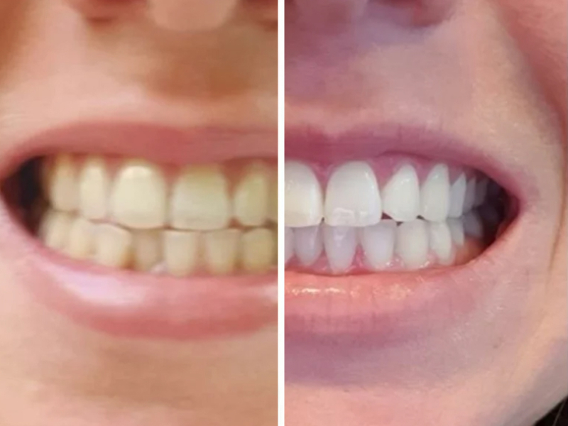 tanden-bleken-alkmaar-before-after