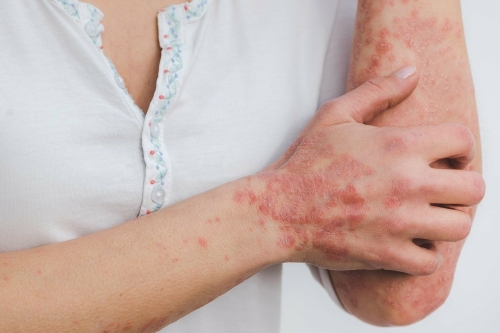 Allergie en jeuk - Levhealthy - Annekie Kiers - Staphorst NEI Therapeut