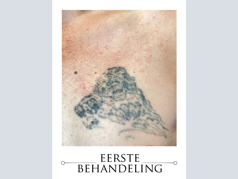 laser verwijdering tattoo roermond