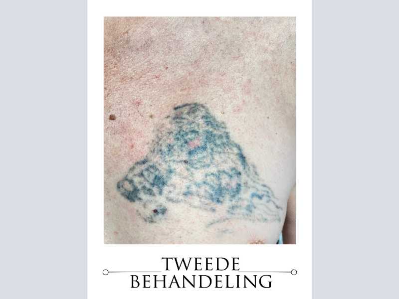 laser tattoo verwijdering omgeving roermond