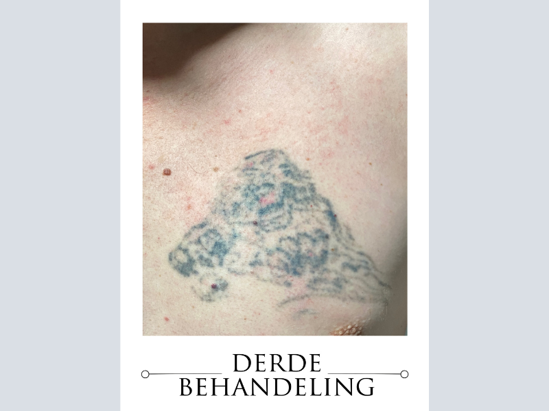 verwijderde tattoo roermond