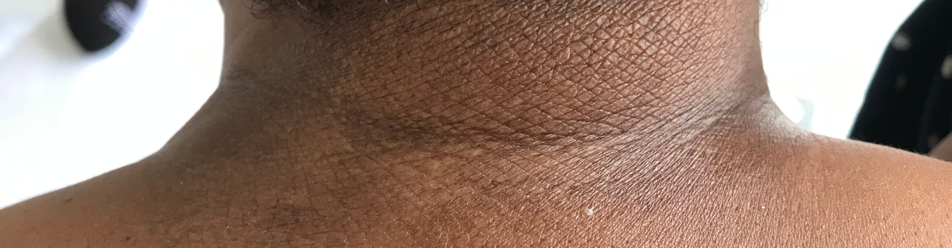 Atopische dermatitis in de donkere huid