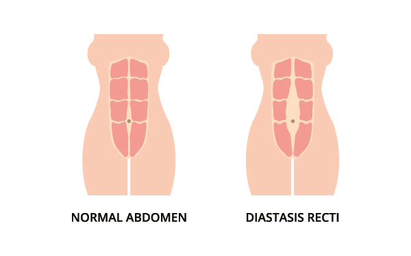 Puntbuik tijdens je zwangerschap: diastase