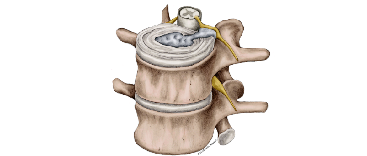 Genezing hernia versnellen met fysiotherapie