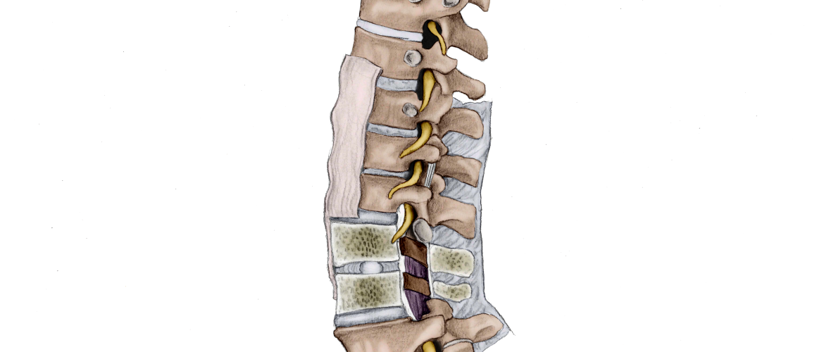 cauda-equina-fysiotherapie-behandeling cauda-equina-fysiotherapie-behandeling
