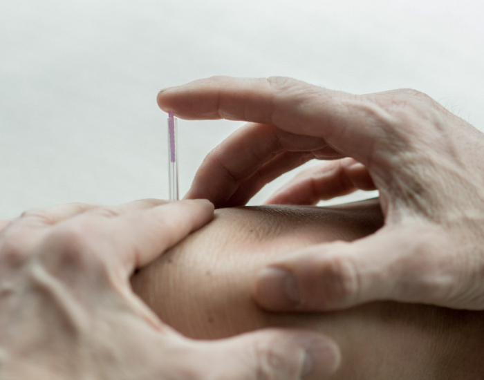 Dry needling Geffen