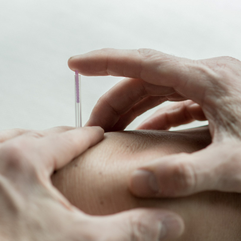 Dry needling Geffen