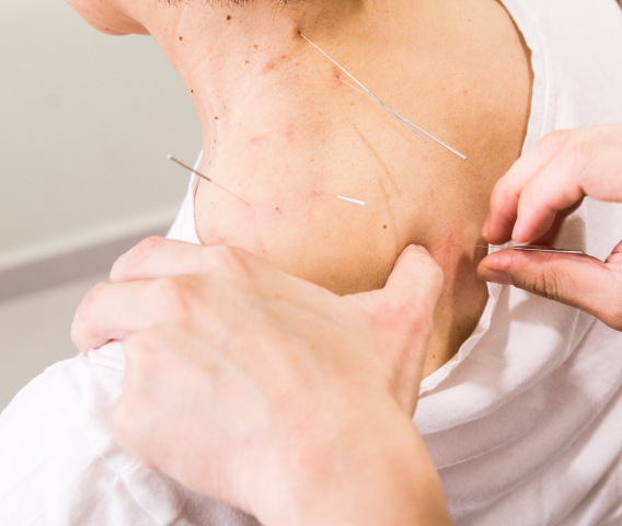 foto van een dryneedling behandeling bij nekklachten nekpijn of andere nekproblemen