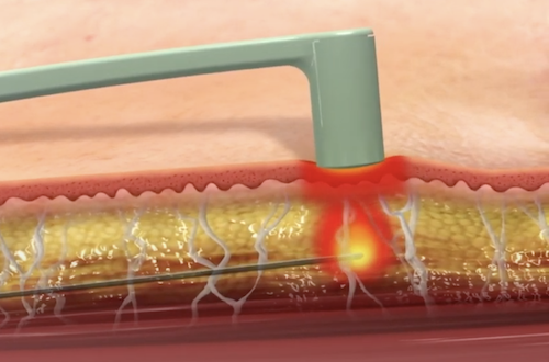 Facetite, Accutite Necktite RF behandeling