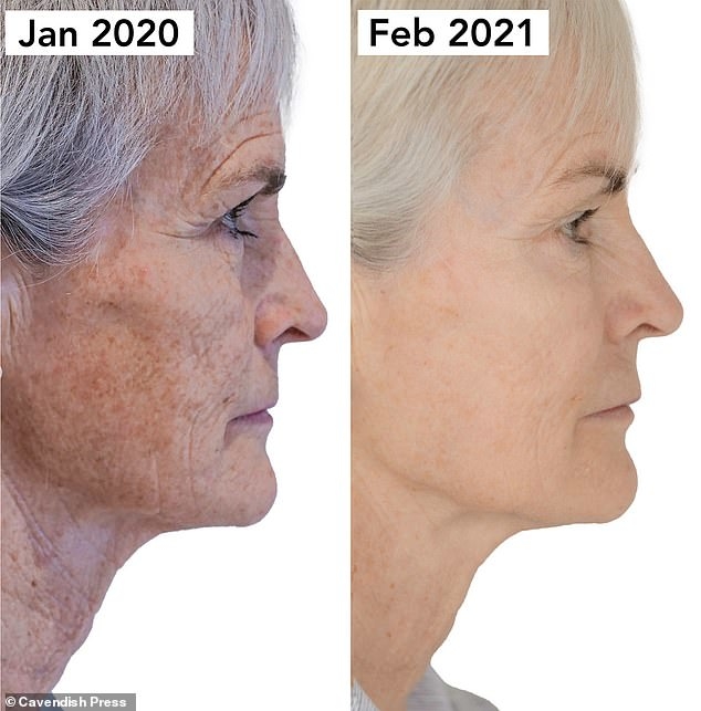 Behandeling met Morpheus8 Body om pigmentvlekken op de huid te verminderen.