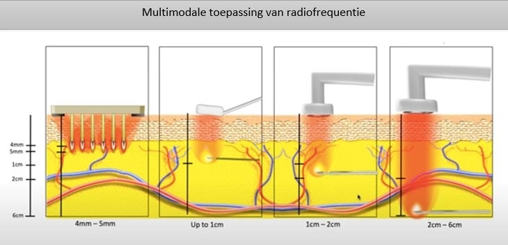 Morpheus8 prijzen