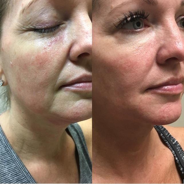 Skinboosters en fillers die gericht worden toegepast om de huid te verbeteren.