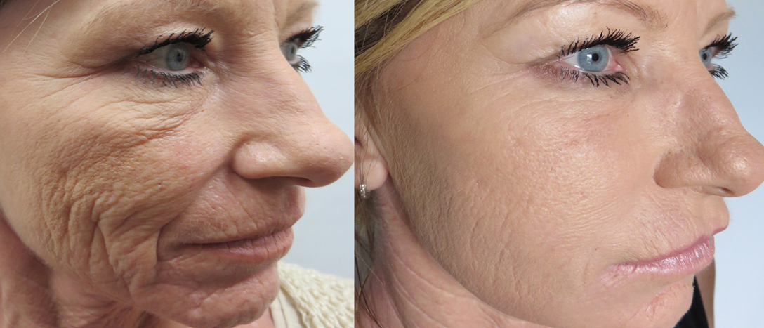 Microneedling behandeling met een Dermapen 4 op de huid.