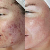 Dermalux led behandeling acne Dermalux led behandeling acne