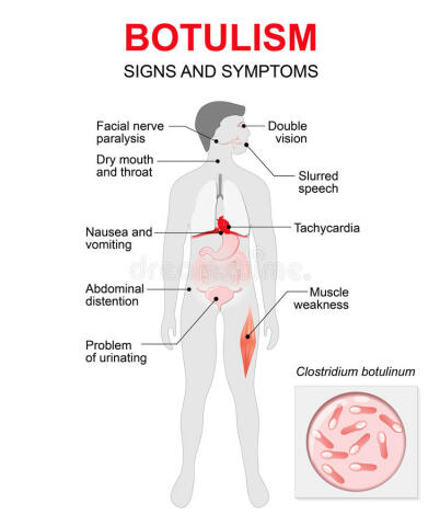 botulisme oorzaak symptomen