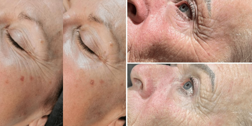 LED en IPL als slimme aanvulling LED- en IPL-behandelingen als gerichte aanvulling op andere huidtherapieën.