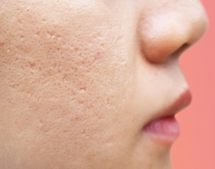 acne littekens huidtherapeut den haag