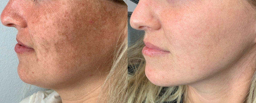 Lumecca Lummeca voor en na