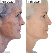 pigmentvlekken verwijderen morpheus8 body Behandeling met Morpheus8 Body om pigmentvlekken op de huid te verminderen.