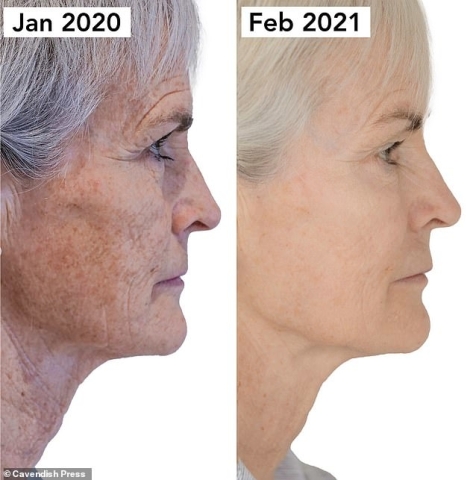 pigmentvlekken verwijderen morpheus8 body Behandeling met Morpheus8 Body om pigmentvlekken op de huid te verminderen.