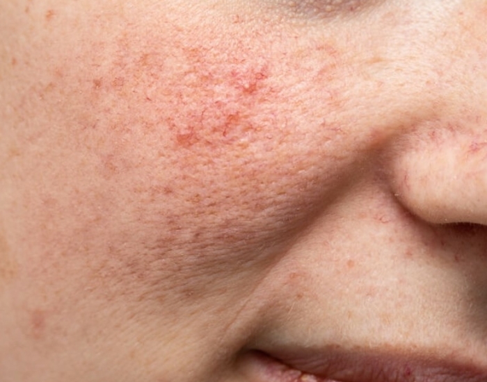 huidveroudering huidtherapeut den haag
