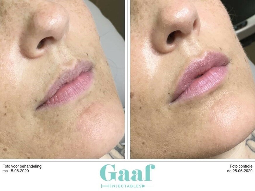 Injectables voor & na foto