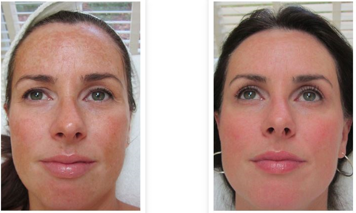 Chemische peelings Chemische peelingbehandeling die de huid exfolieert om de textuur en teint te verbeteren.