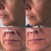 skinboosters-rimpels-bovenlip-fillers Behandeling met skinboosters en fillers om rimpels boven de bovenlip te verminderen.