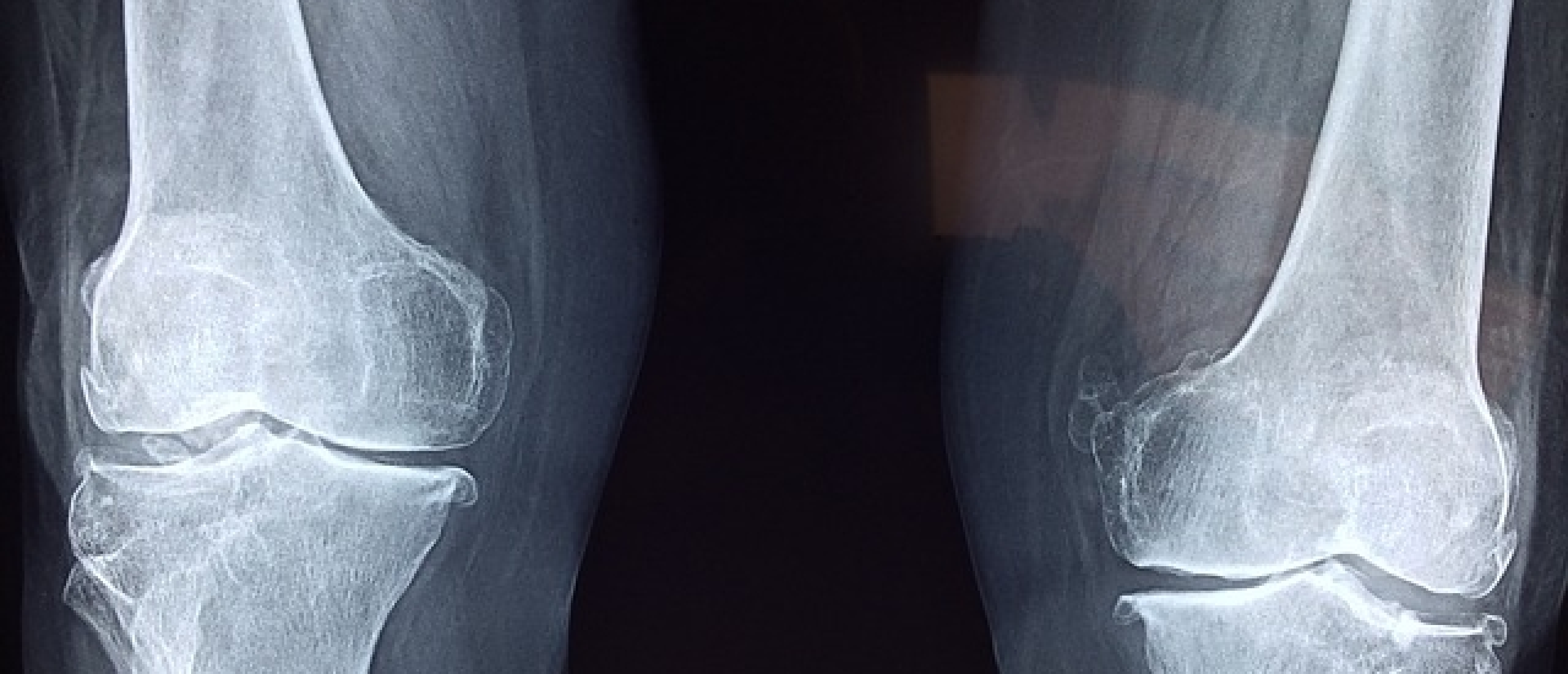 Pijn in de knie onstaat door verschillende redenen