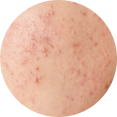 Acne Arnhem