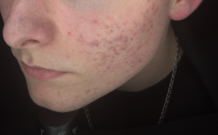 Acne Arnhem