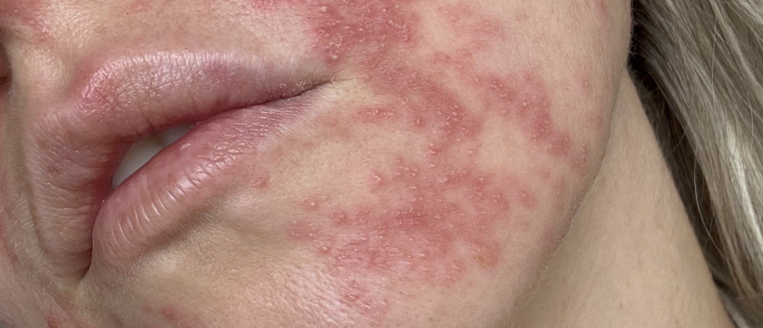Dermatitis Perioalis