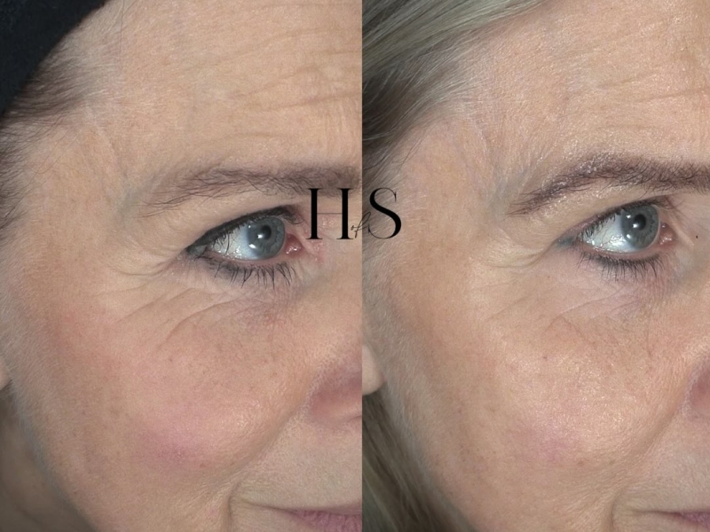 Resultaat microneedling