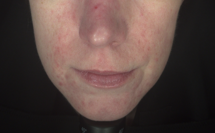 Rosacea Arnhem