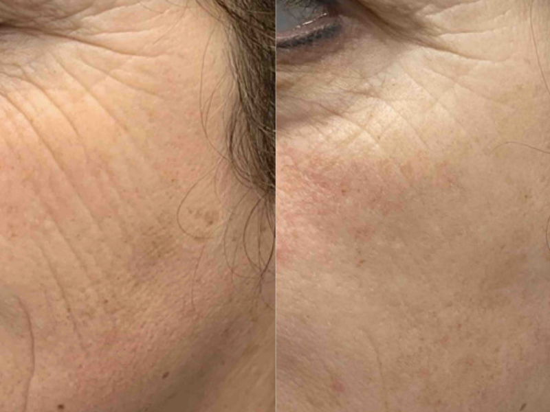 Skinpen rimpels verminderen