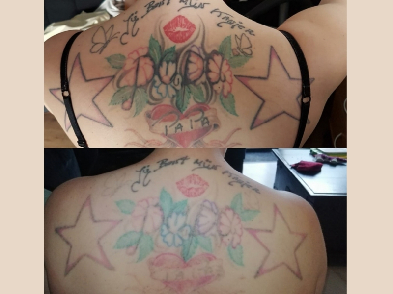 Tattoo weghalen Arnhem