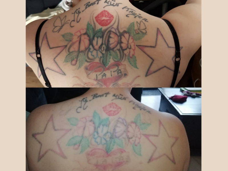 tattoo verwijderen Arnhem voor en na