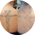 tattoo verwijderen Arnhem voor en na tattoo verwijderen Arnhem voor en na