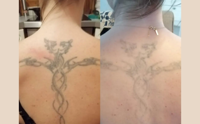 tattoo verwijderen Arnhem voor en na