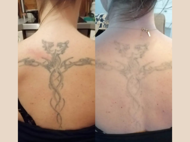 Tattoo laseren Arnhem