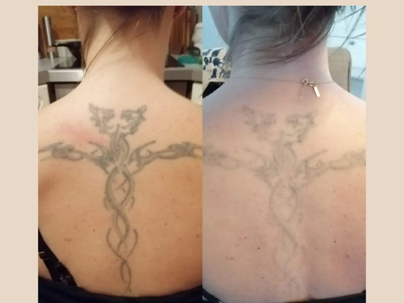 tattoo verwijderen Arnhem voor en na