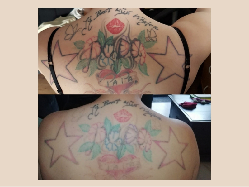 tattoo verwijderen Arnhem voor en na tattoo verwijderen Arnhem voor en na