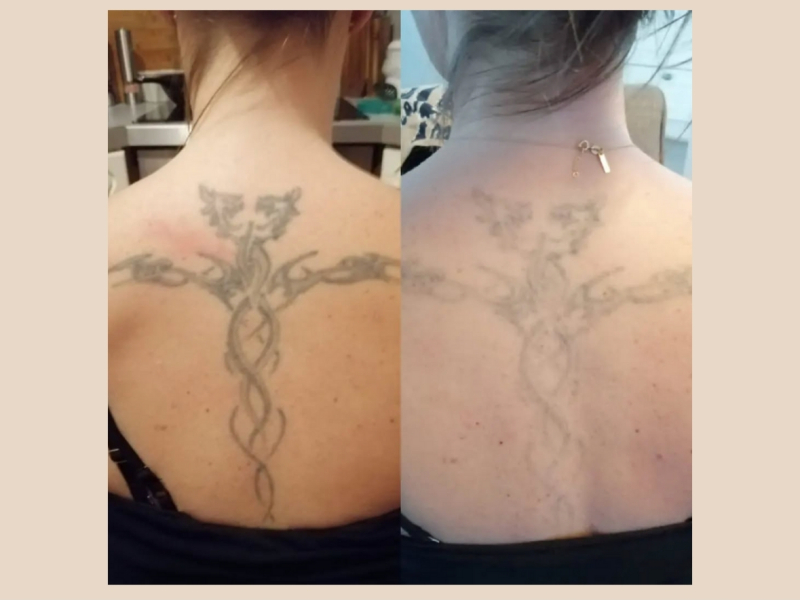 tattoo verwijderen Arnhem voor en na tattoo verwijderen Arnhem voor en na