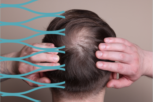 alopecia-areata-voor-hoofdhuidprofessionals