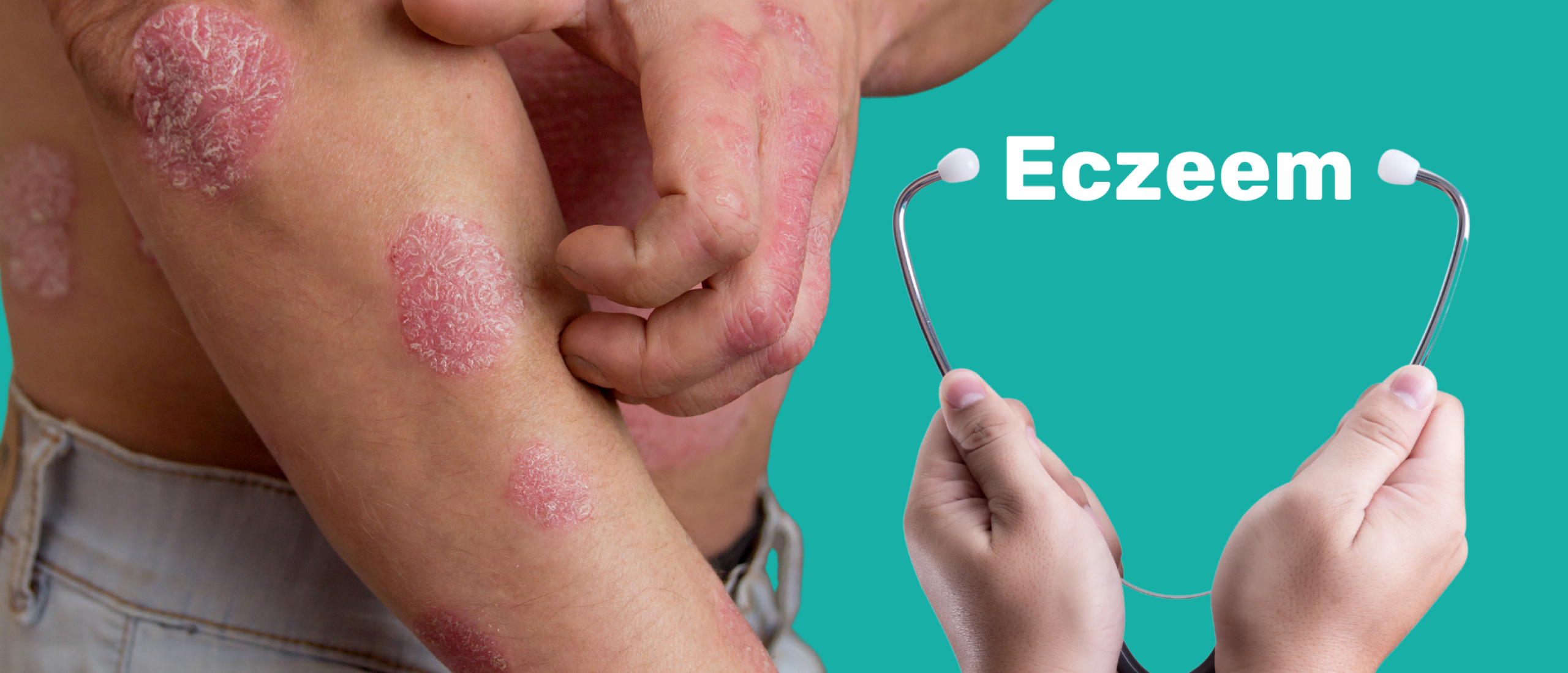 The importance of biomarker testing in eczema treatment