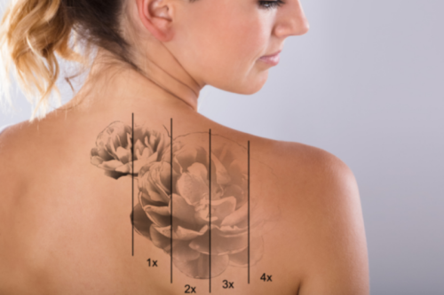 tattoo verwijderen met laser