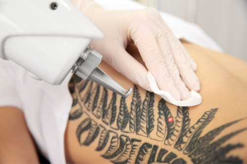 tattooshop apeldoorn tattoo verwijderen