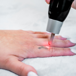 Tattoo op vinger verwijderen met laser